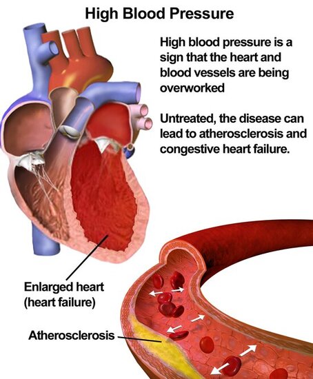 What High Blood Pressure Does To Your Body