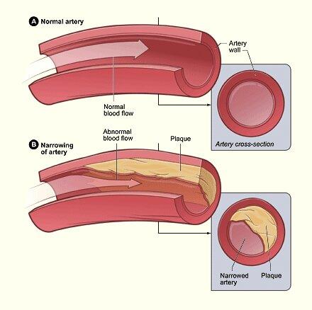 What Is High Blood Cholesterol