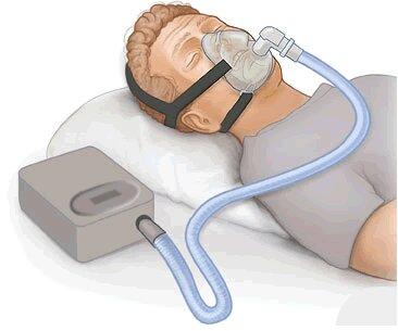 Continuous Positive Airway Pressure (CPAP)