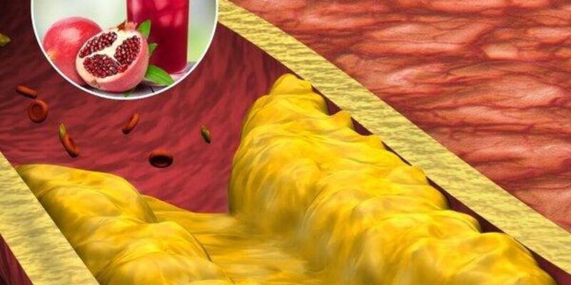 One Cup of Pomegranate Juice Daily. 30% Reduction in Artery Blockage